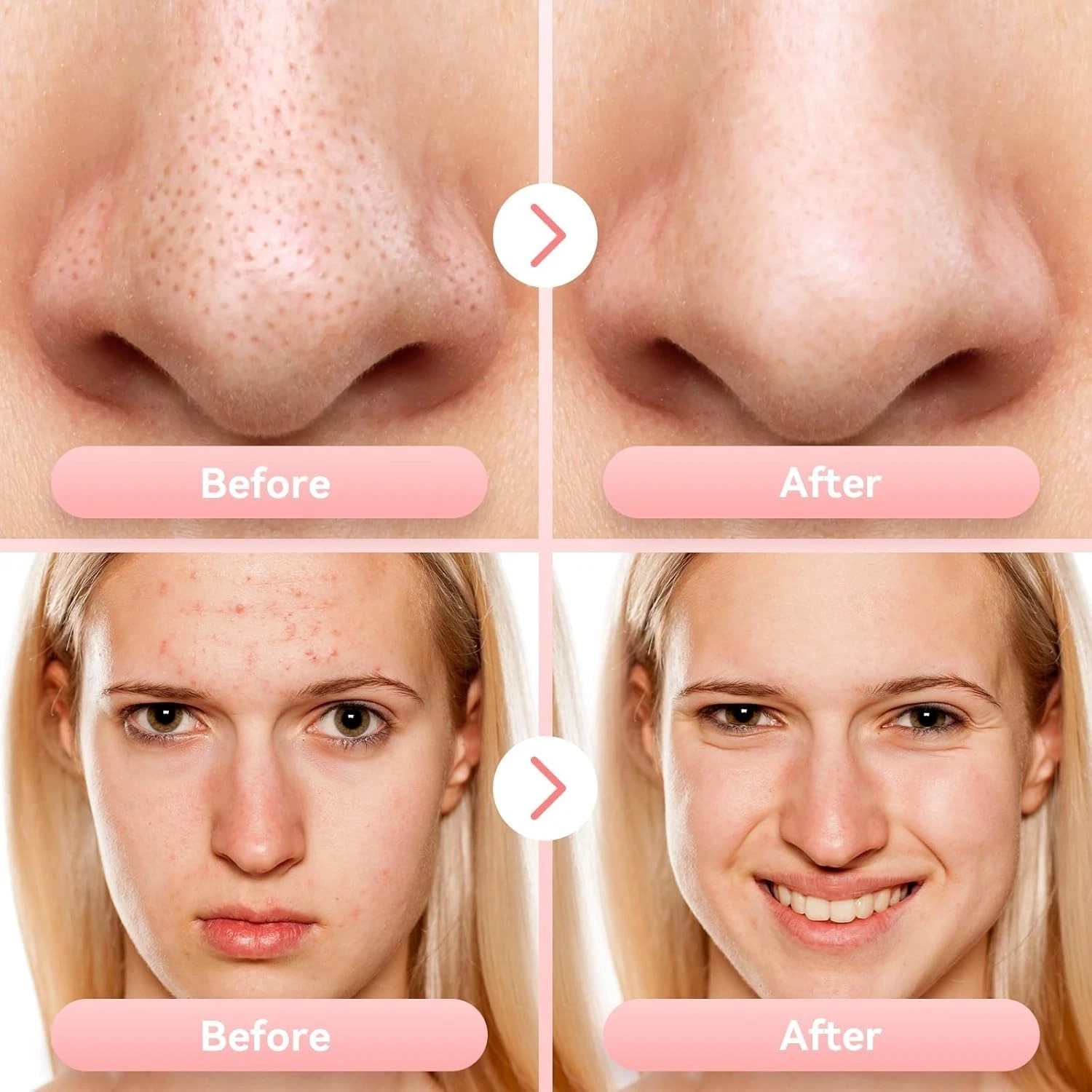 Blackhead Remover Pore Vacuum Upgraded Facial Pore Cleaner Electric Comedone …