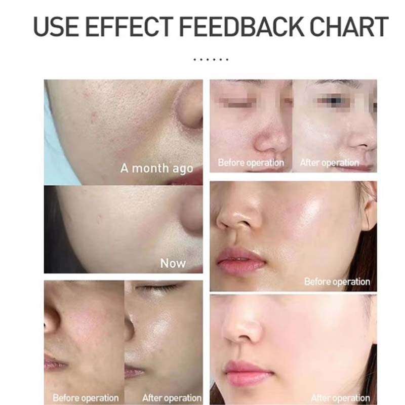 Skin Whitening Hydrating Rejuvenation Water Light Skin Beauty Equipment