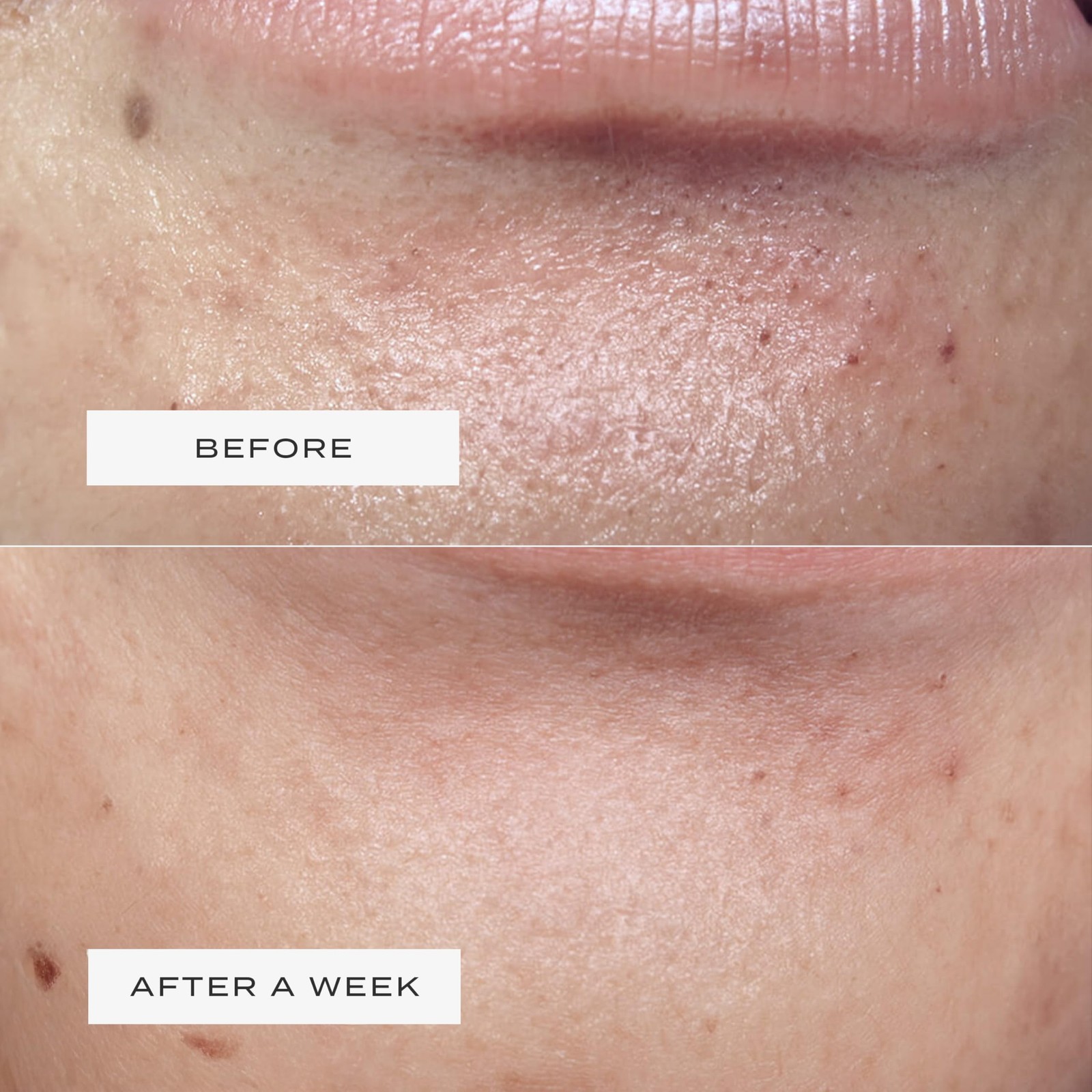 Vue Chin Patches – Hydrocolloid Pore for and Jawline Small