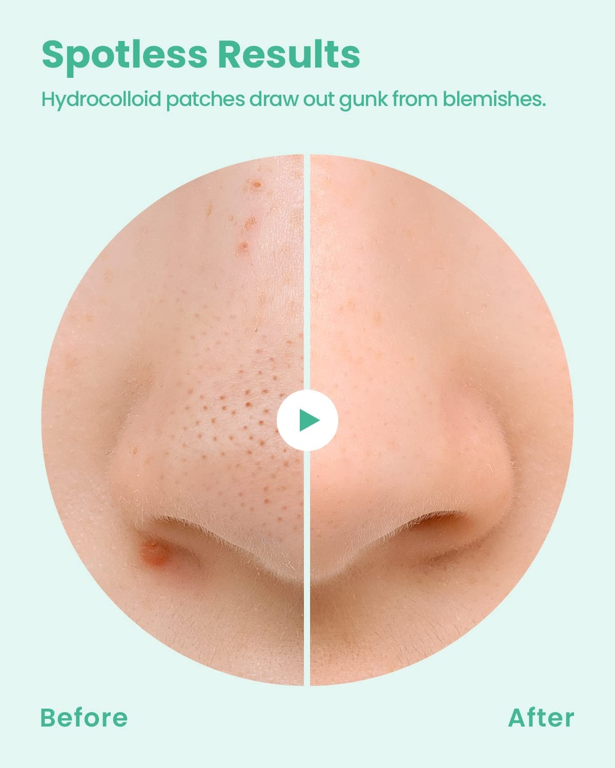 GLAM UP Spotless Nose Patch Hydrocolloid Coverage for 12 Count (Pack of 1)