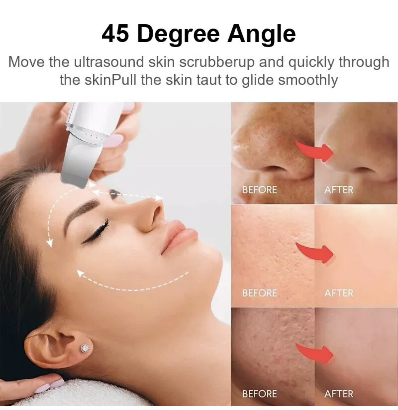 Eliminador De Espinillas Limpiador De Poros Sonico para Limpieza Facial Profunda