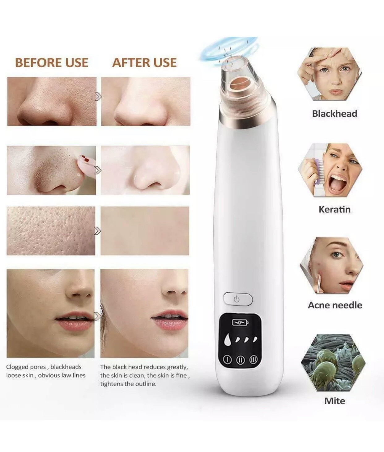 Blackhead Remover acne extractor hot compress, USB Pore Cleaner, LED display