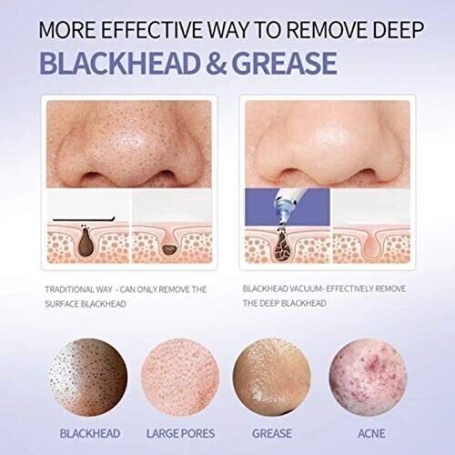 BulbHead DermaSuction Derma Suction Pore Cleaning Device With Vacuum Action
