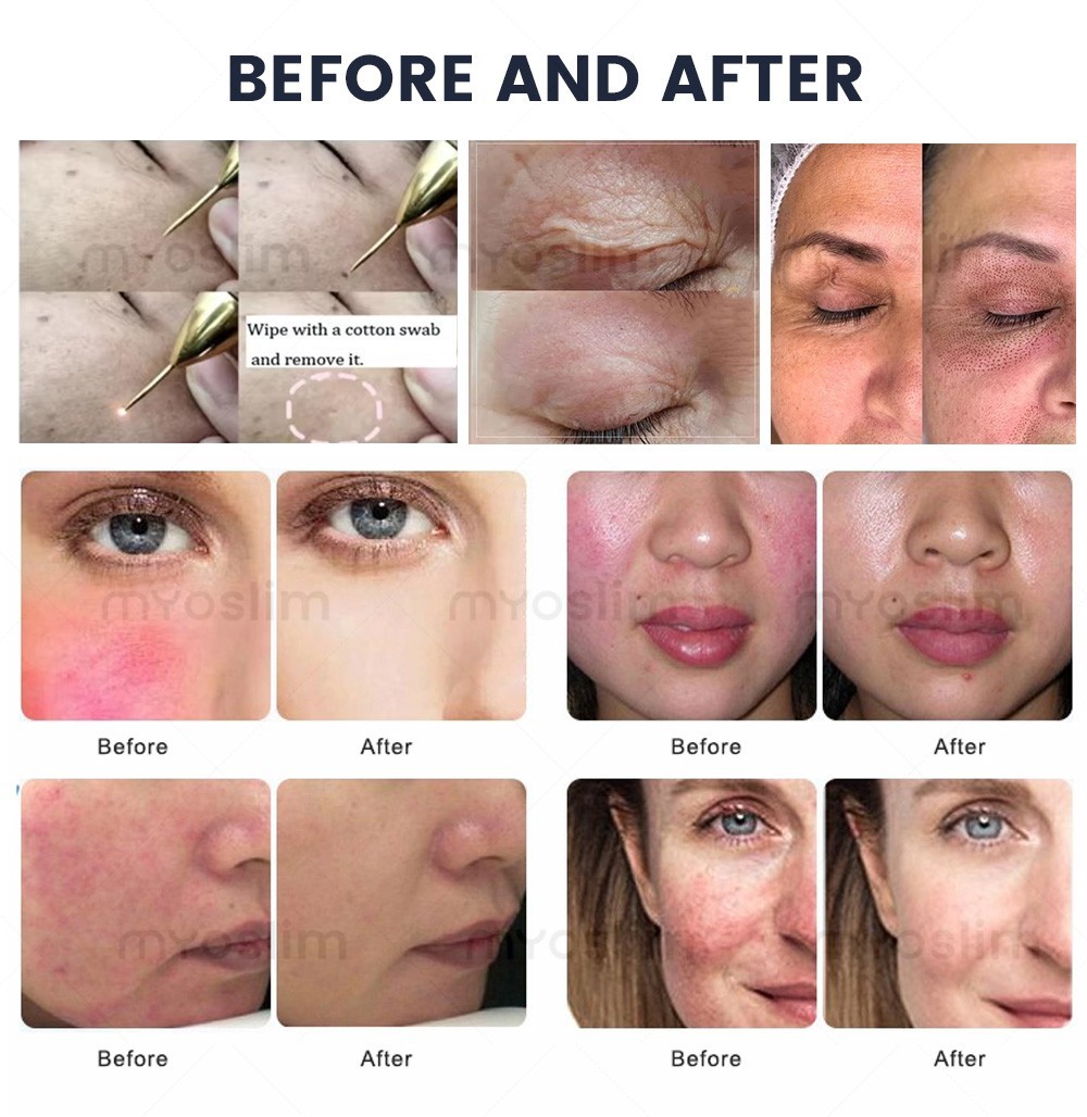 Ozone Gold Plasma Face Care Machine 2 in 1 Anti-Aging Skin Lifting Tightening