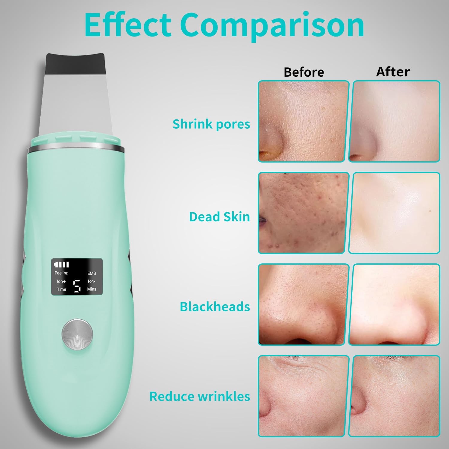 Face Scrubber Skin Spatula – Blackhead Remover 1 Count (Pack of 1), Green