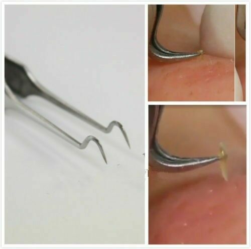 Blackhead Pimple Remover Tweezers Acne Blemish Whitehead Comedone Face Cleaner