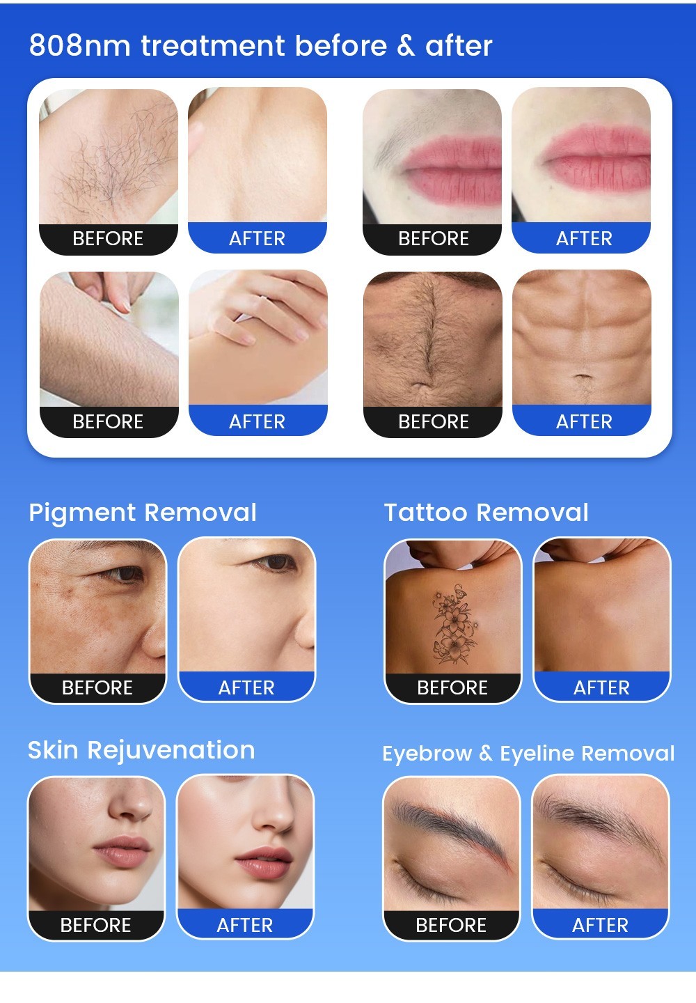4-in-1 Multifunction Beauty Device Hair removal, skin tightening, tattoo removal