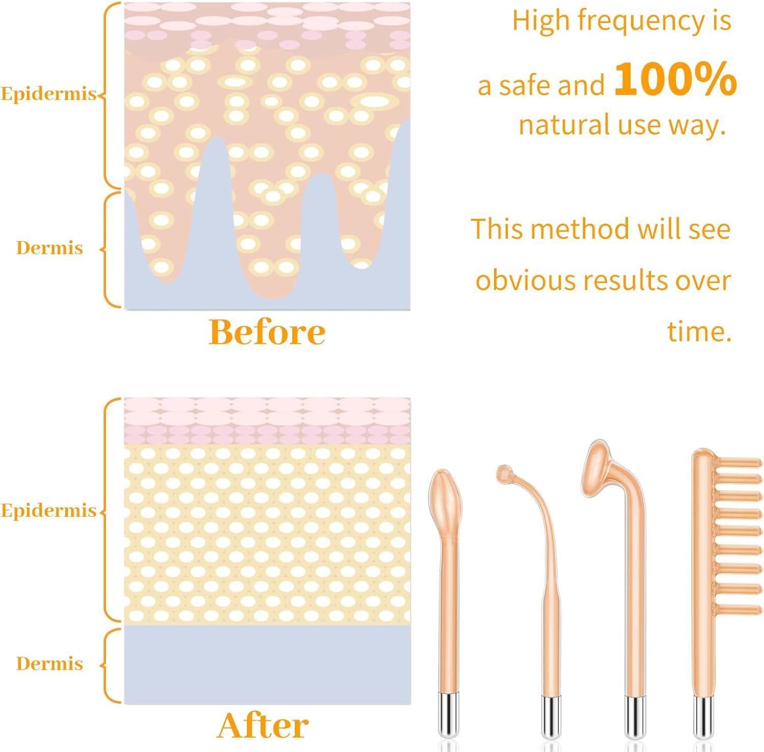 Mã¡quina Portã¡til Para Terapia De Alta Frecuencia Facial Acnã© Manchas Arrugas