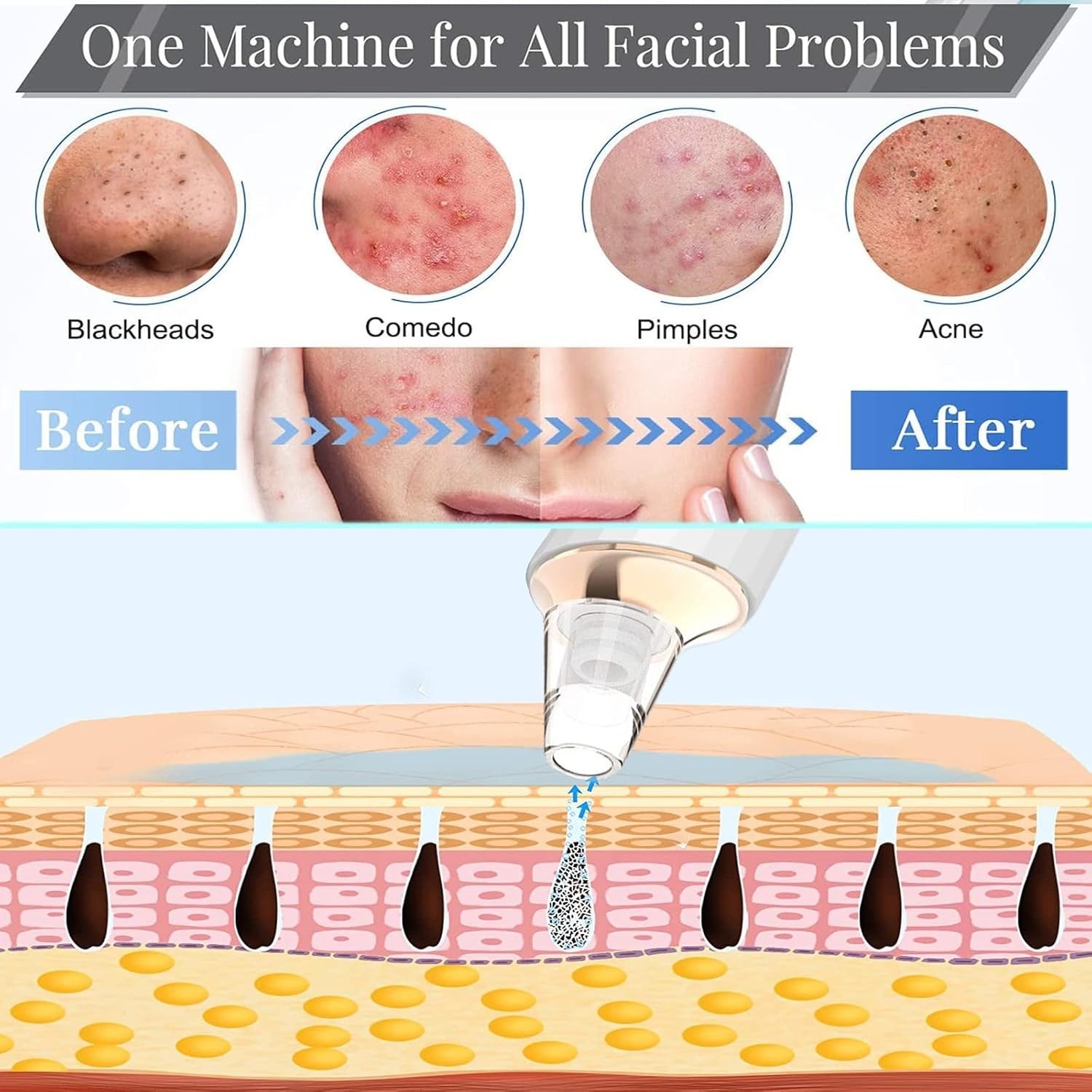 Blackhead Remover Pore Vacuum, Upgraded USB Rechargeable Facial Pore Cleaner …