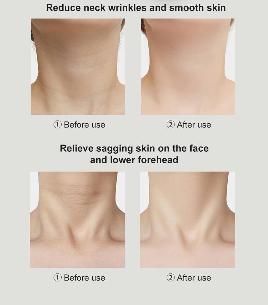 Pulsed Light Wrinkle Reducing Instrument