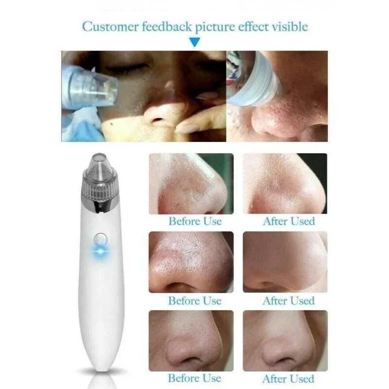 AQ-77961 BLACKHEAD ACNE FACIAL CLEANSING VACUUM SUCK UP DIRT RECHARGEABLE