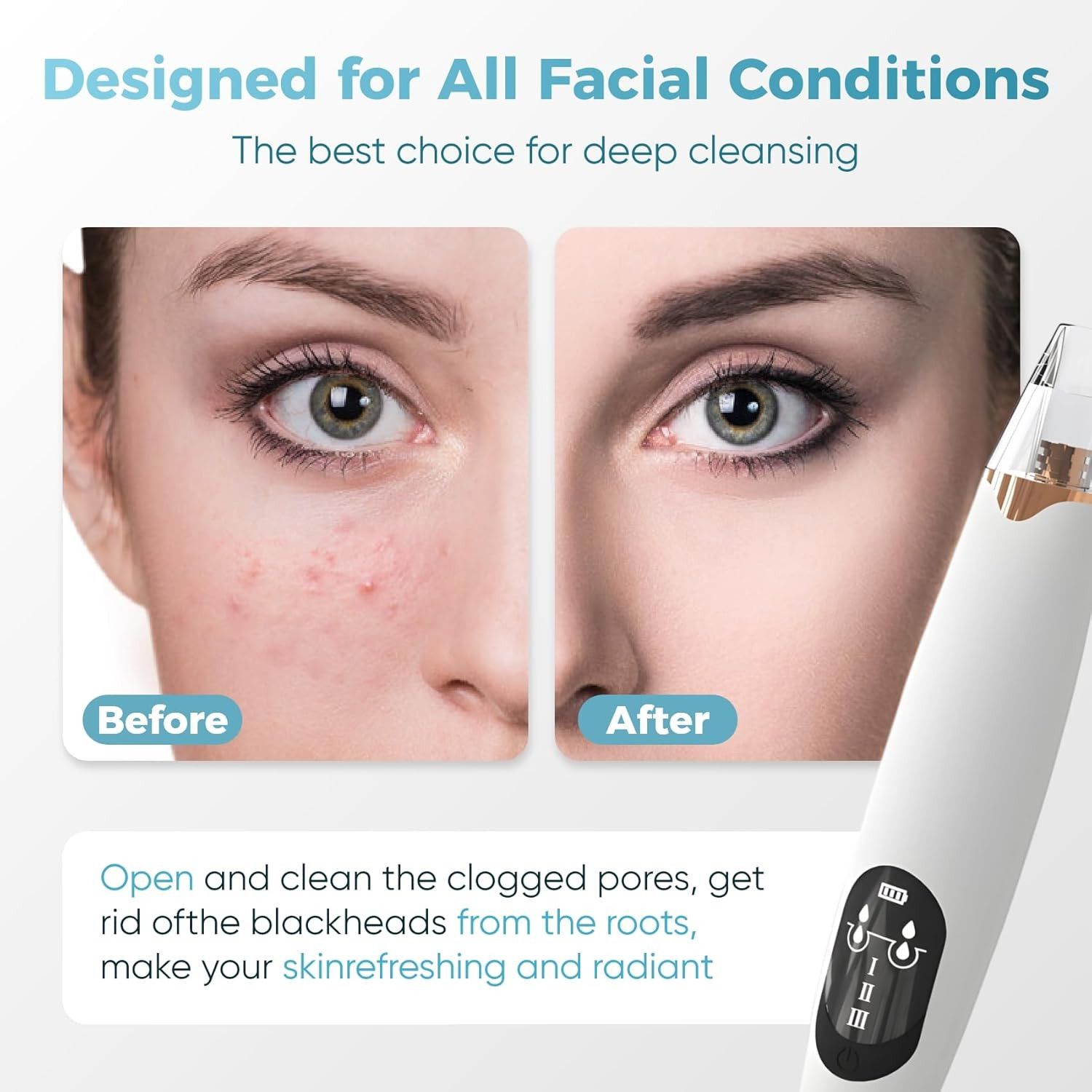 Facial Pore Blackhead Remover Vacuum – Facial Pore Cleaner 3 Adjustable Suction