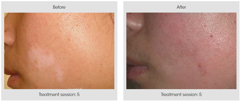 Eximal 308nm Excimer UV-light (Vitiligo, Psoriasis, and Skin Disease Treatments)