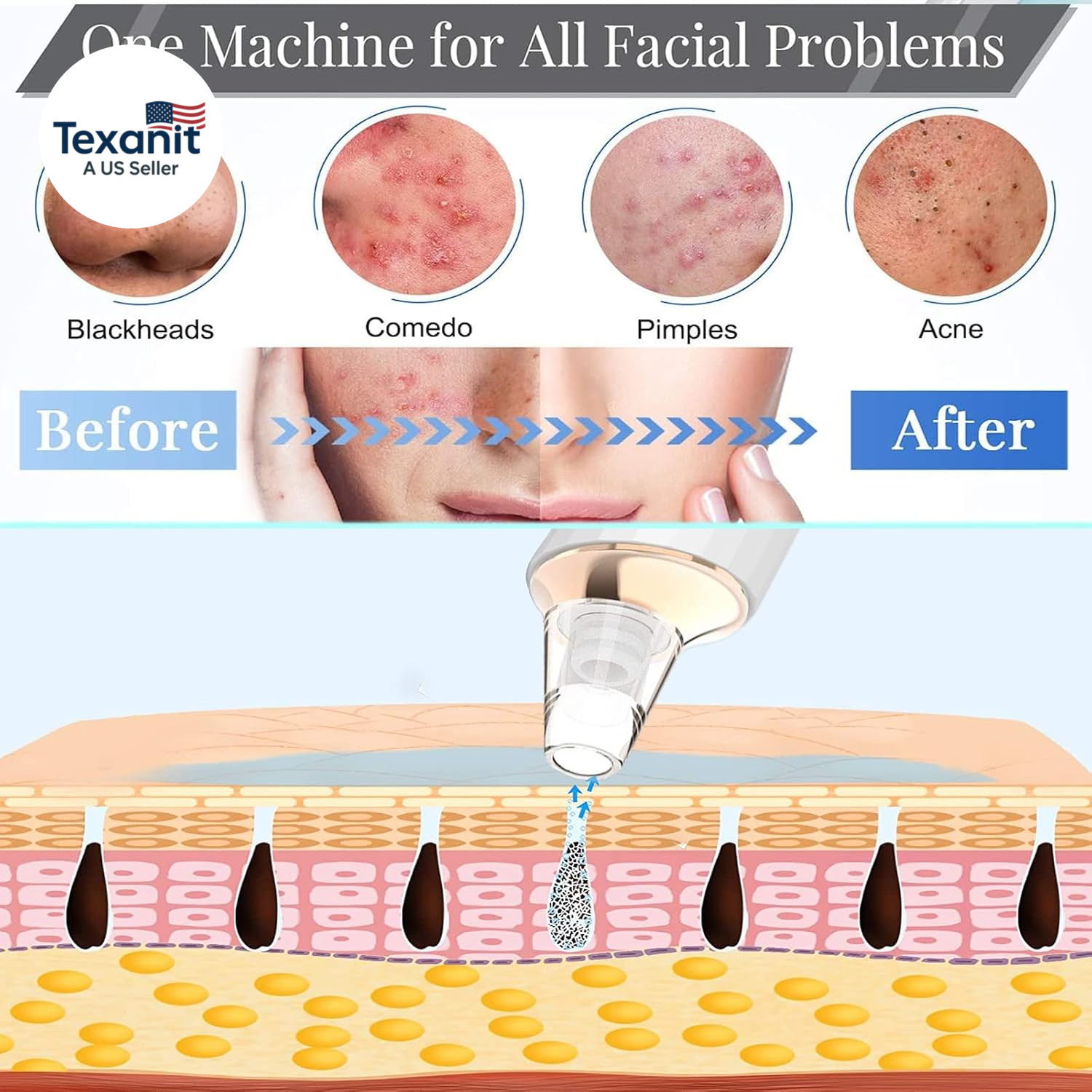 Blackhead Remover Pore Vacuum, Upgraded USB Rechargeable Facial Pore Cleaner Bla