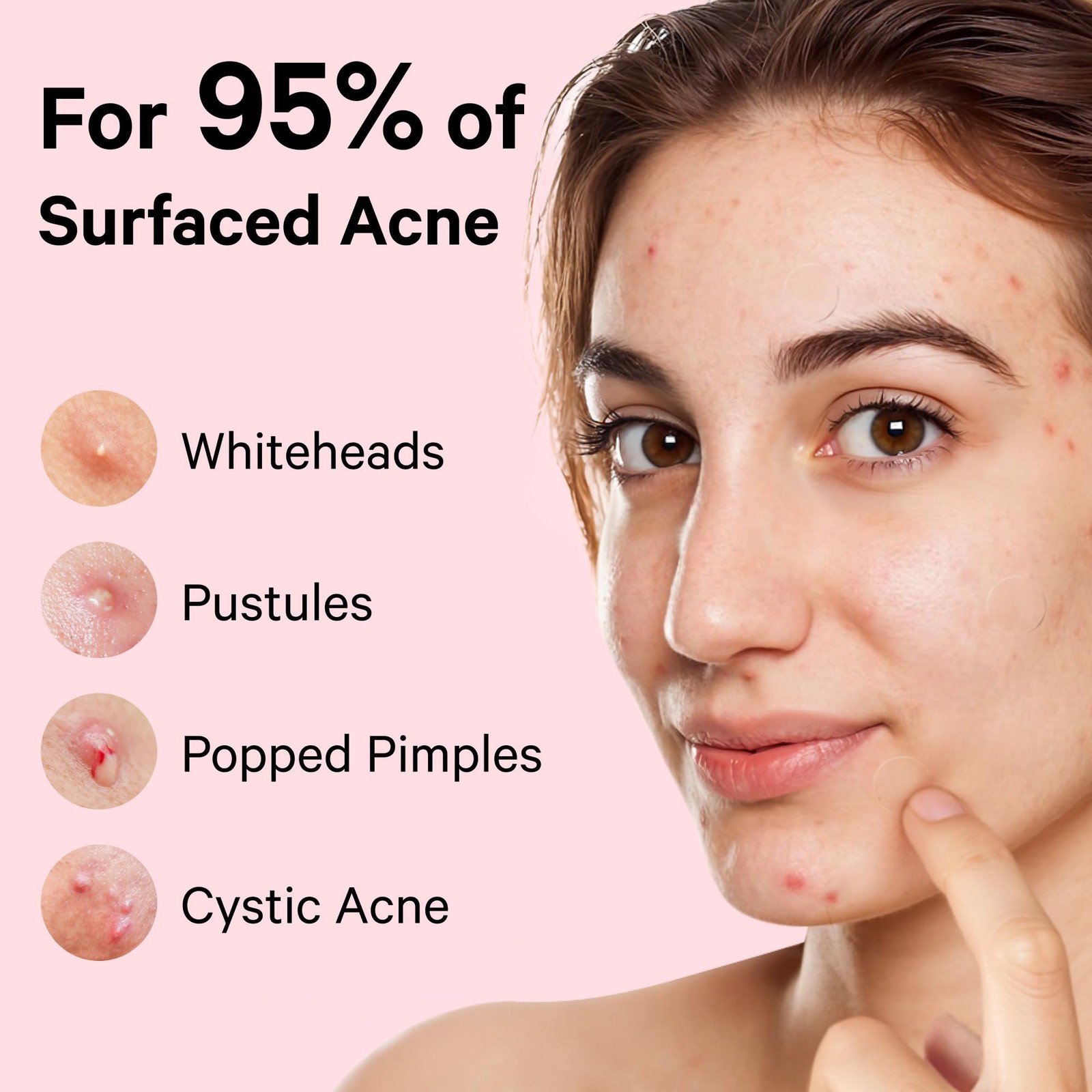 Sosky Pimple Patches for Face, Hydrocolloid Acne with Transparency