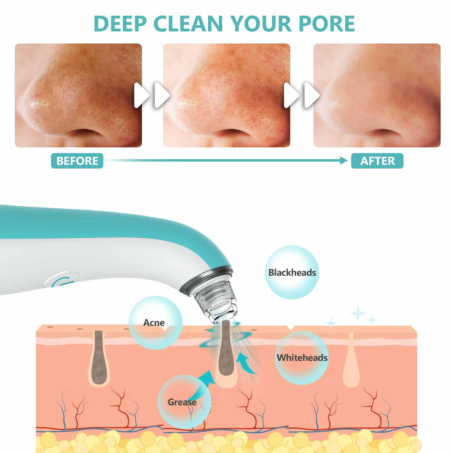 Blackhead Remover Pore Vacuum with 4 Replaceable Suction Probes Light Blue NEW