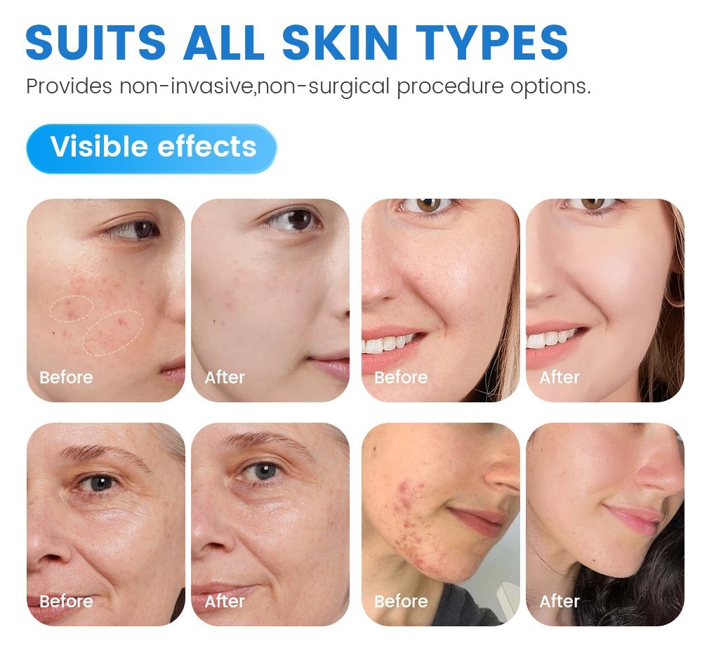 6 in 1 Facial Cleaning Skin brightening Acne Blackhead Removal beauty Machine