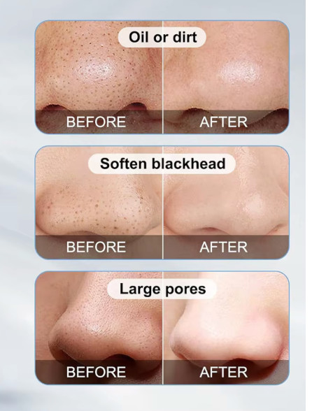 Electric Blackhead Remover Vacuum Pore Cleaner Acne Suction Skin Tool Kit