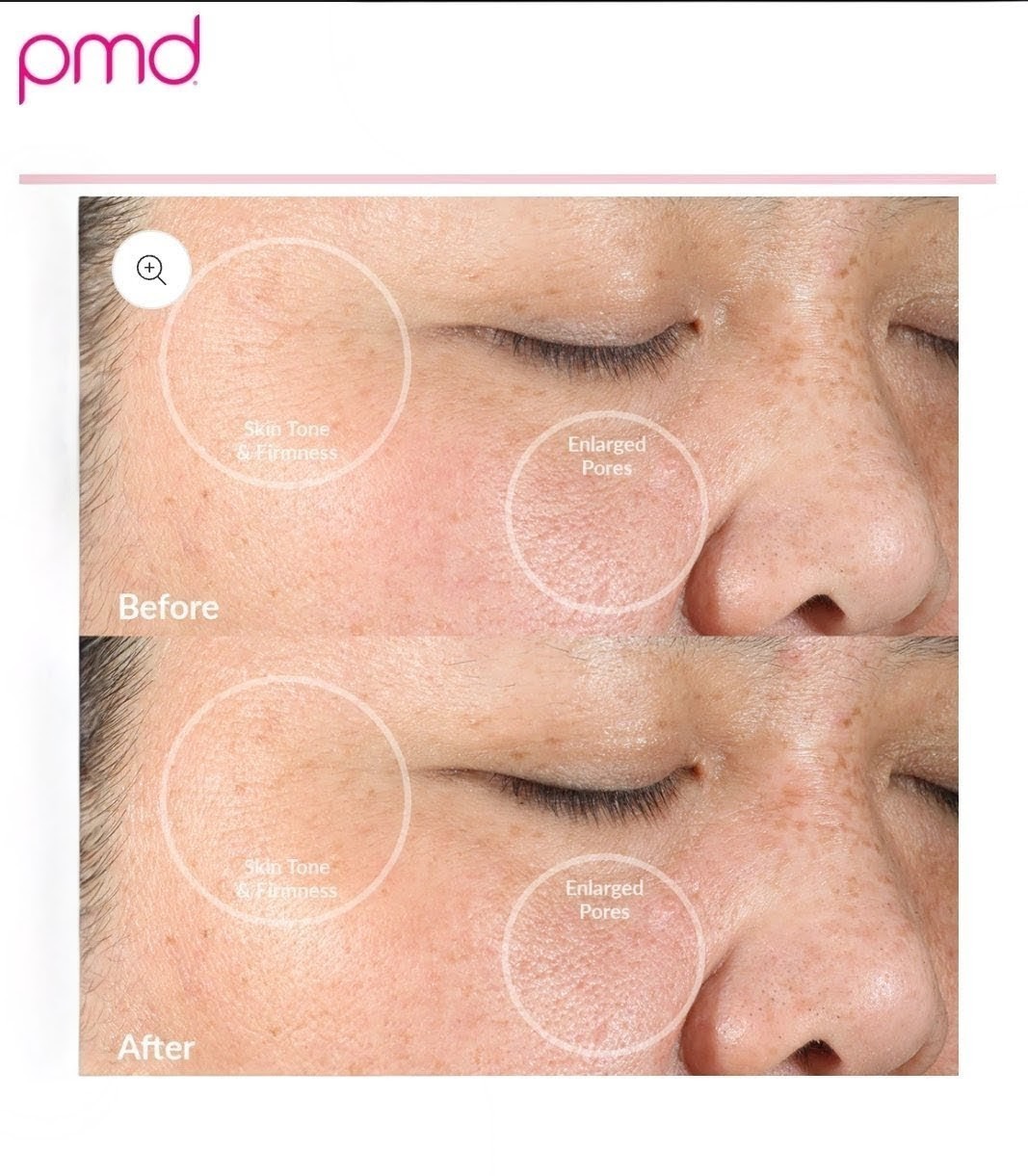 NEW | PMD Clean Facial Cleansing Device – “Blush” | Skincare Technology