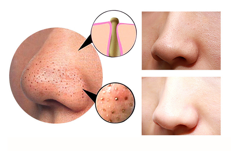 4 in 1 Body Guasha Cupping Blackhead Remover Machine Facial Pore Deep Cleansing