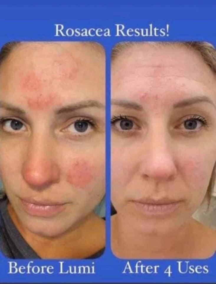 LumiSpa IO Skincare Device Facial Cleansing