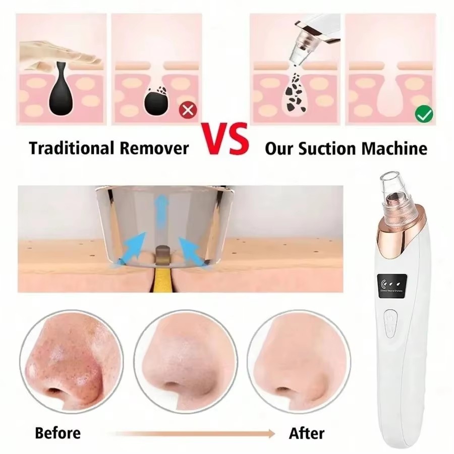 Electric Blackhead Remover Vacuum 5 Suction Pore Cleanser