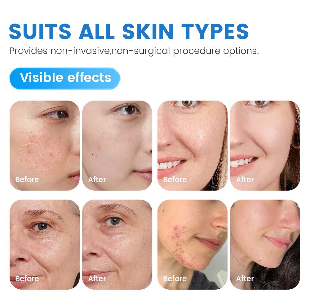 7 IN 1 Water Dermabrasion Oxygen Wrinkle Reduction Skin Care Hydro Facial Device
